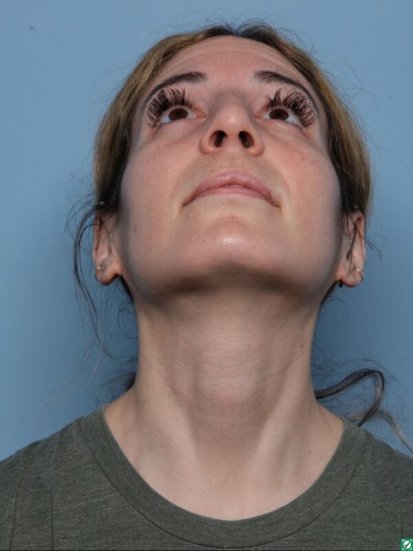 Rhinoplasty