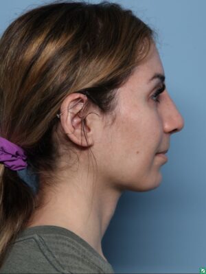 Rhinoplasty