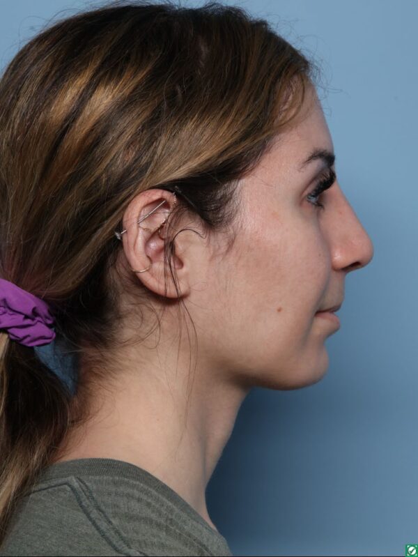 Rhinoplasty
