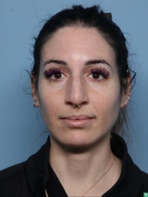 Rhinoplasty