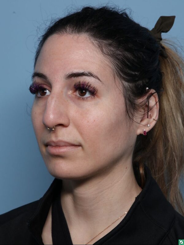 Rhinoplasty