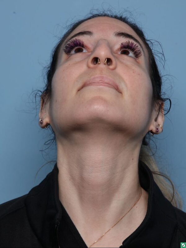 Rhinoplasty