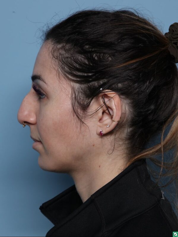 Rhinoplasty