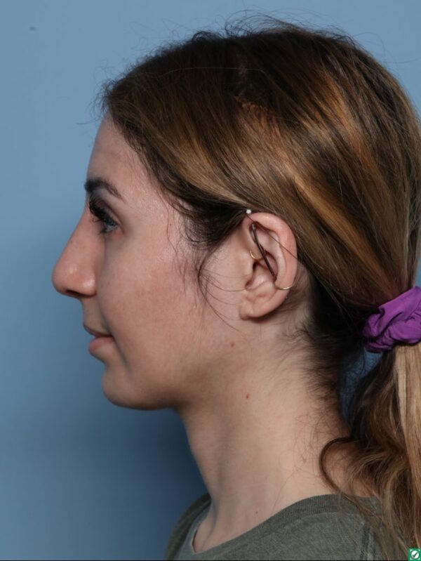 Rhinoplasty
