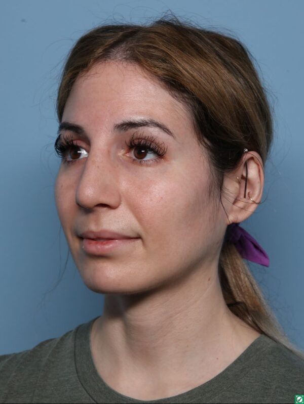 Rhinoplasty