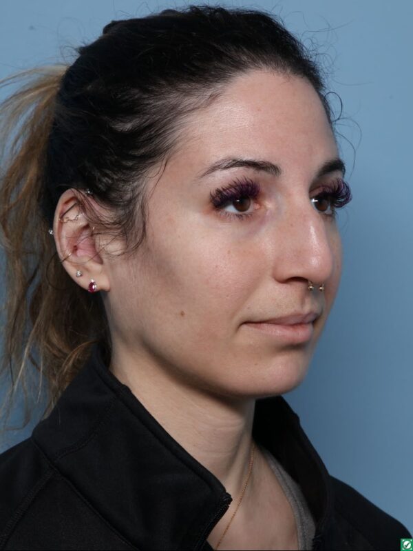 Rhinoplasty