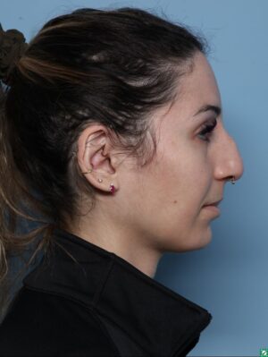 Rhinoplasty