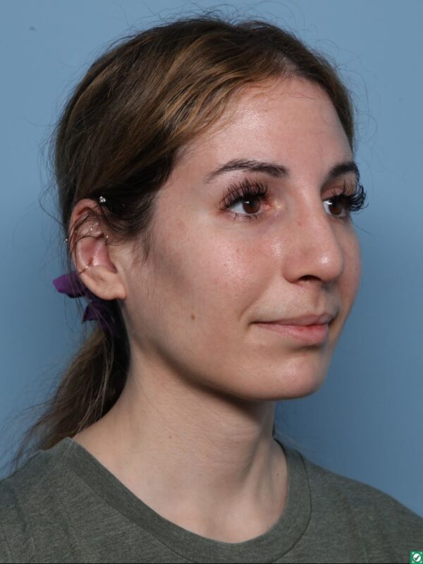 Rhinoplasty