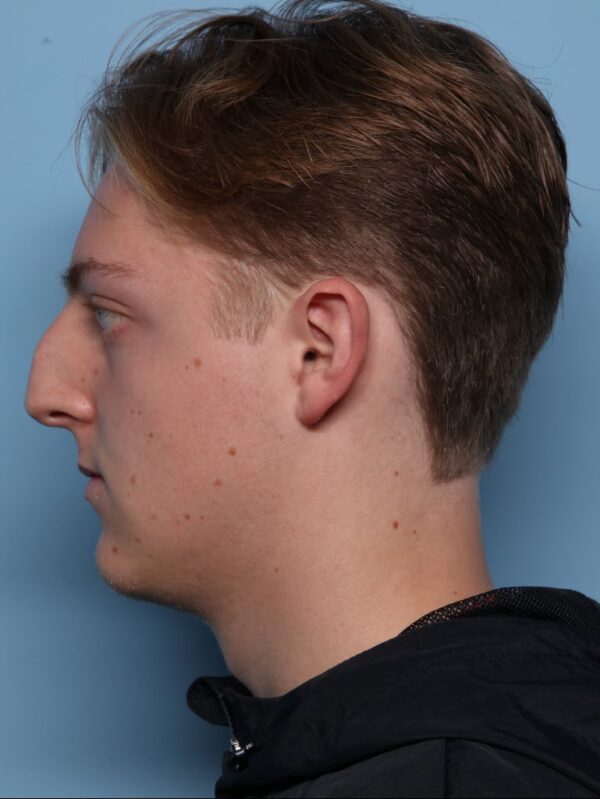 Rhinoplasty