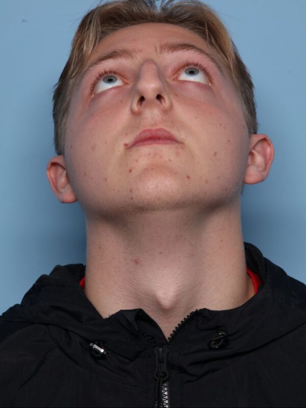 Rhinoplasty