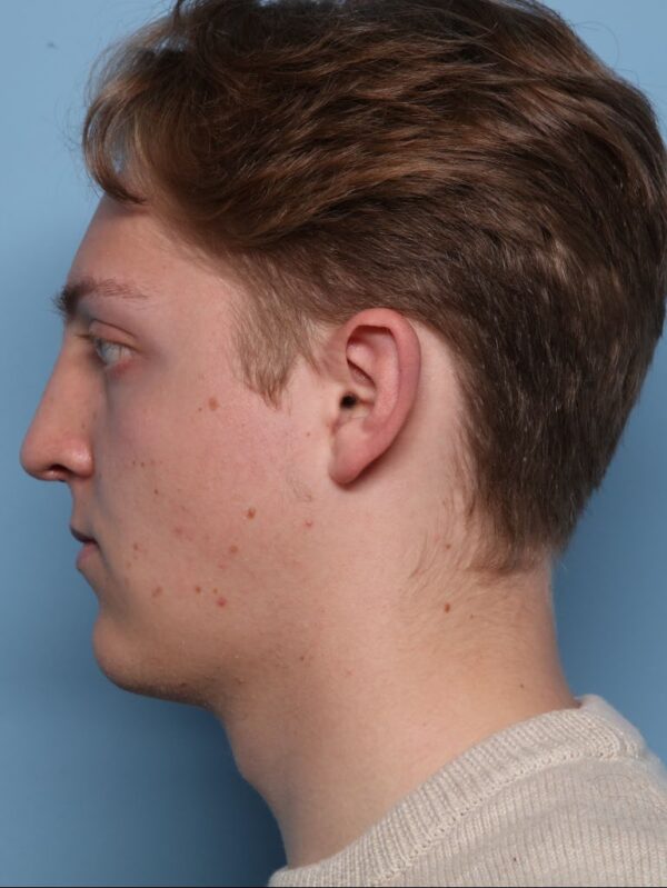 Rhinoplasty