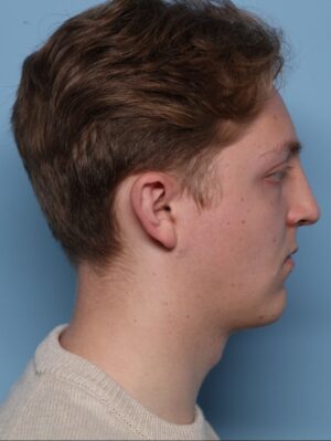 Rhinoplasty