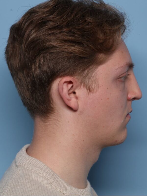 Rhinoplasty