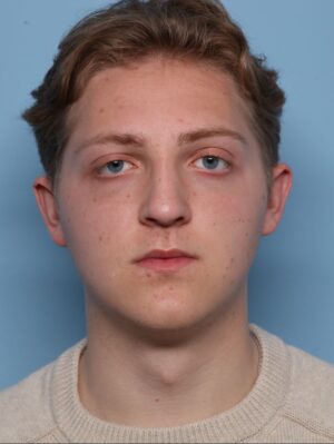 Rhinoplasty