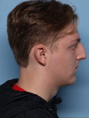 Rhinoplasty