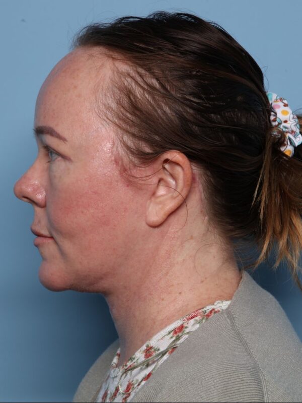 Blepharoplasty