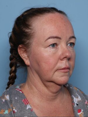 Blepharoplasty