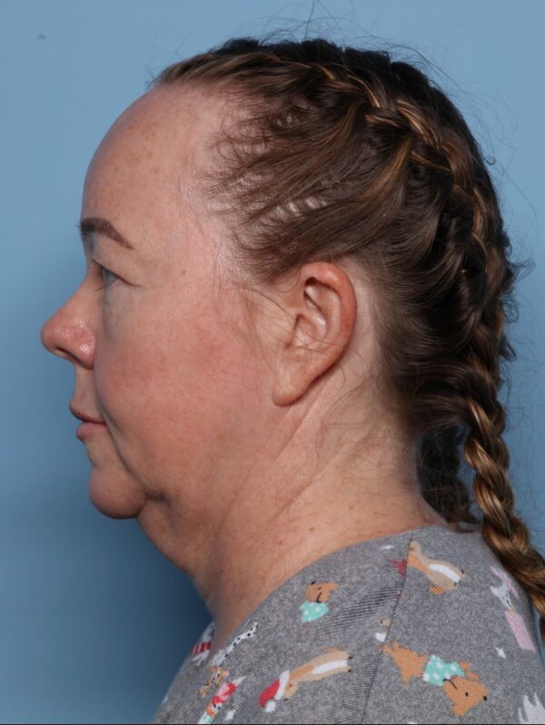Blepharoplasty