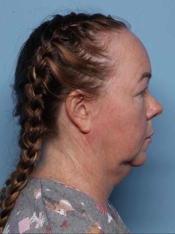 Blepharoplasty