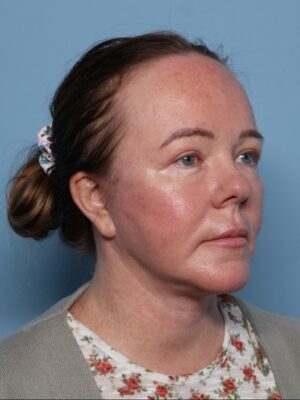 Blepharoplasty