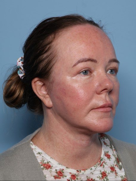Blepharoplasty