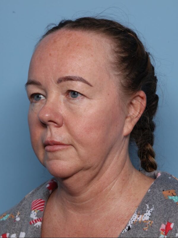 Blepharoplasty