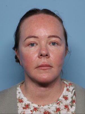 Blepharoplasty