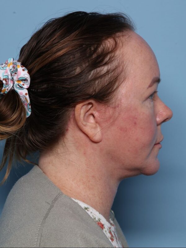 Blepharoplasty