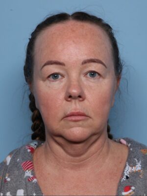 Blepharoplasty