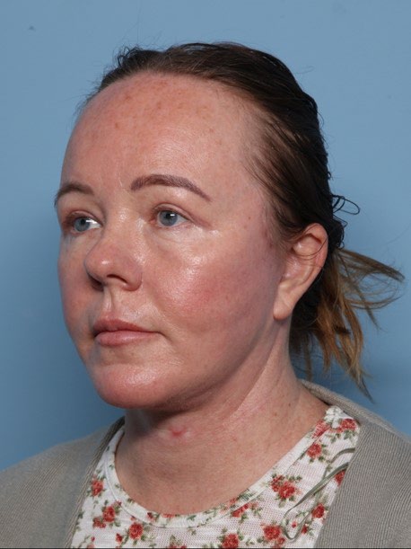 Blepharoplasty