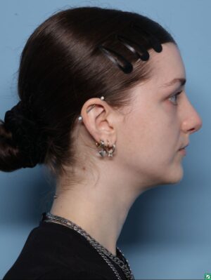 Rhinoplasty