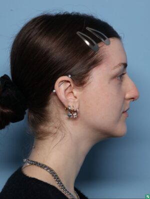 Rhinoplasty