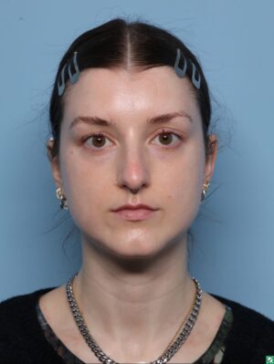Rhinoplasty