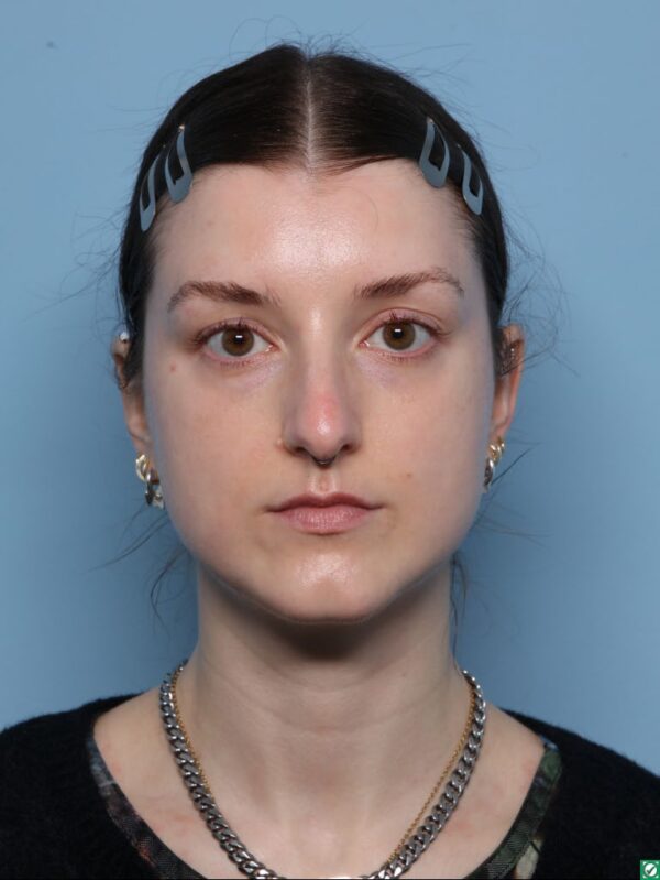 Rhinoplasty