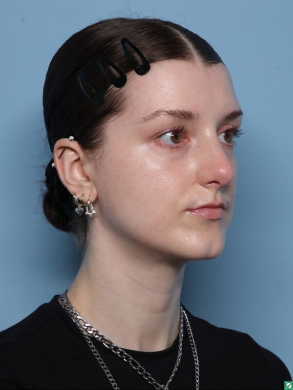 Rhinoplasty