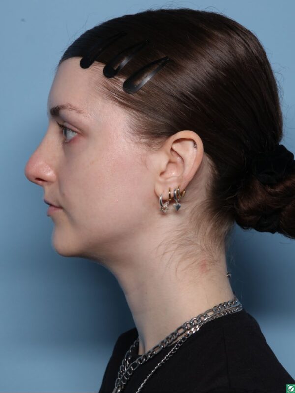 Rhinoplasty