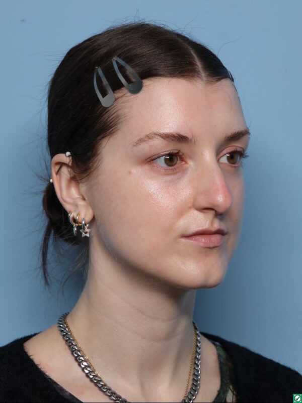 Rhinoplasty