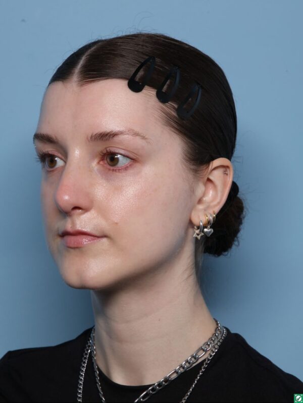 Rhinoplasty