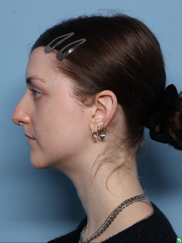 Rhinoplasty