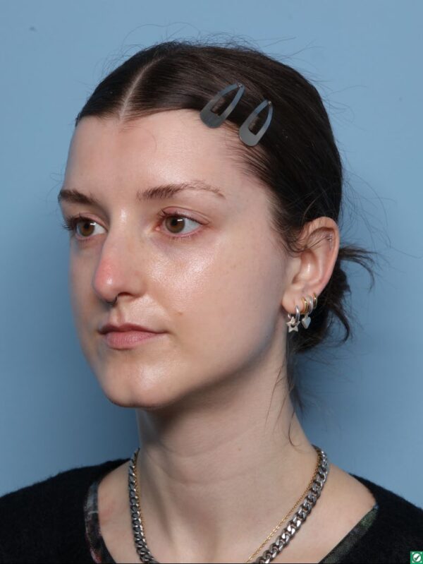Rhinoplasty