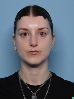 Rhinoplasty