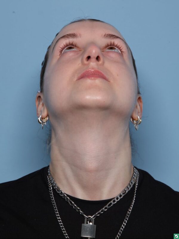 Rhinoplasty