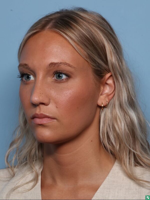 Rhinoplasty