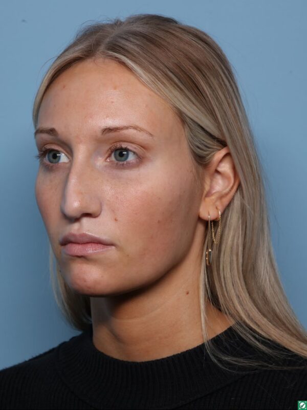 Rhinoplasty