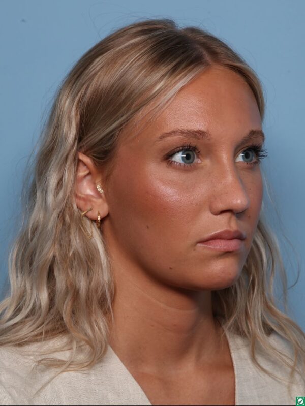 Rhinoplasty