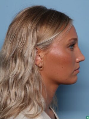 Rhinoplasty