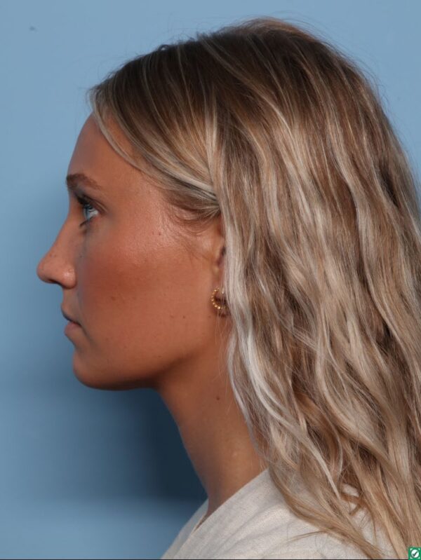 Rhinoplasty
