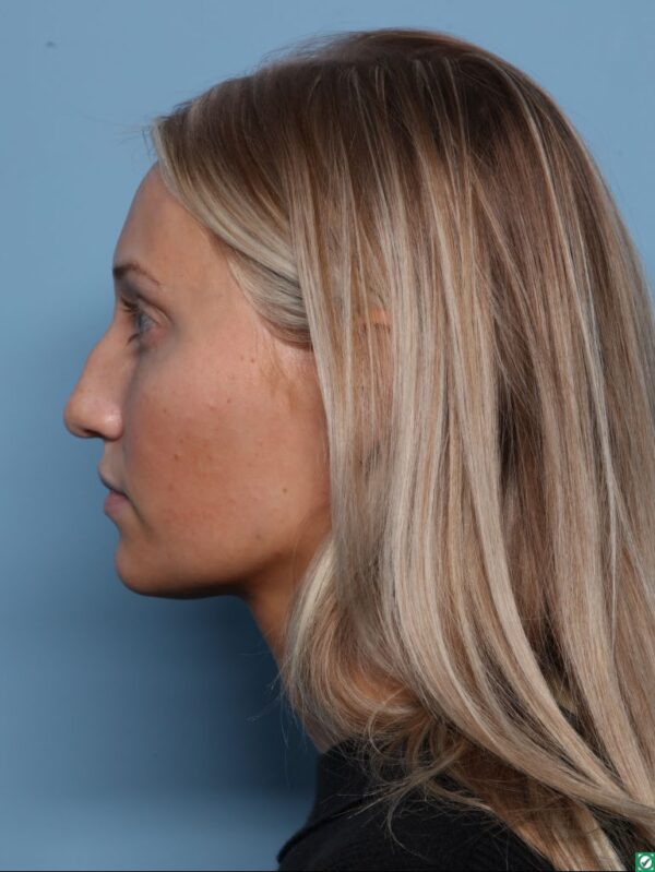 Rhinoplasty