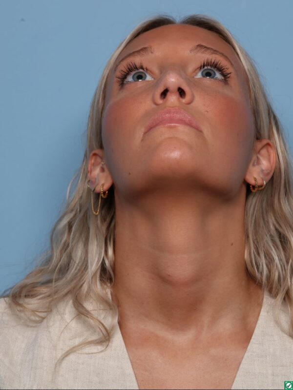Rhinoplasty