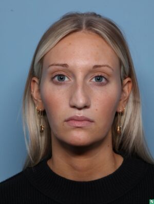 Rhinoplasty